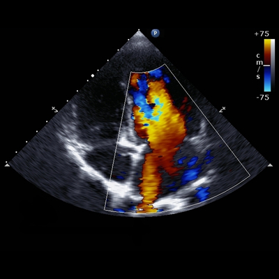 Ultrasound Echocardiography